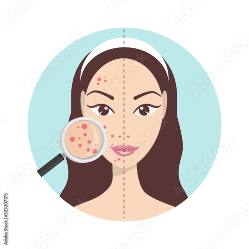 Acne skin problems. Teenage girl with magnifying glass for looking cystic acne on her facial. Vector illustration