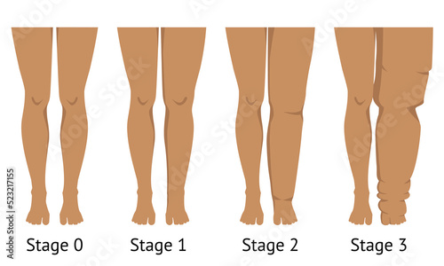 Women's legs in different stages of Lymphedema photo