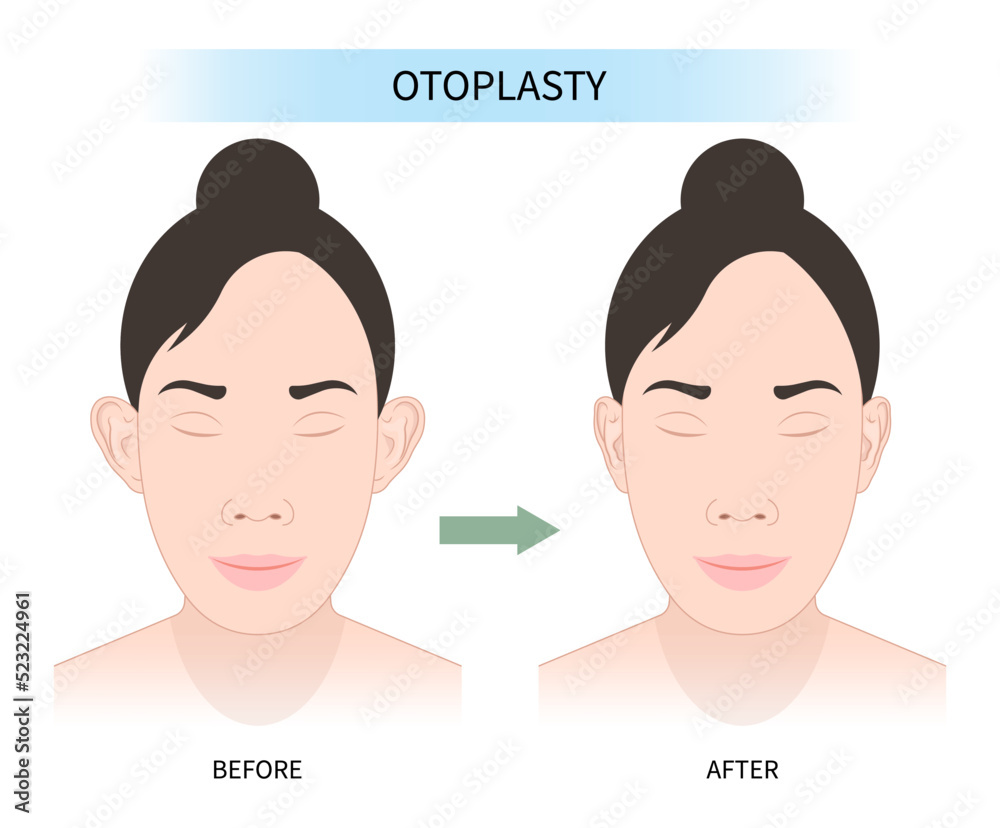 Women face with Ear pinned reshape Corrective lop earlobes deformities