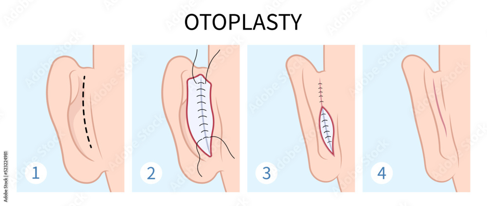Back view of Ear pinned reshape Corrective lop earlobes deformities Back view of Ear pinned reshape Corrective lop earlobes deformities