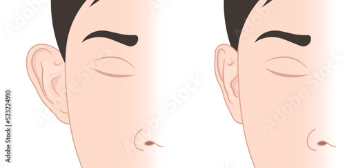 Compare between normal and Ear deformities with pinned reshape Corrective lop earlobes