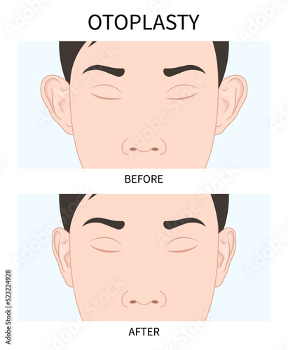 Before and after of Ear pinned reshape Corrective lop earlobes deformities