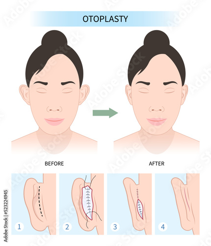 Ear surgery for deformities lop and earlobes pinned reshape Corrective