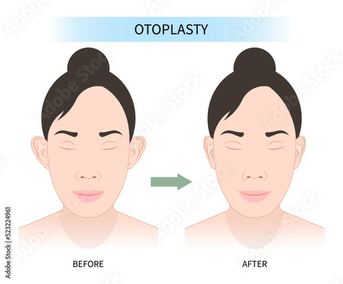 Women face with Ear pinned reshape Corrective lop earlobes deformities