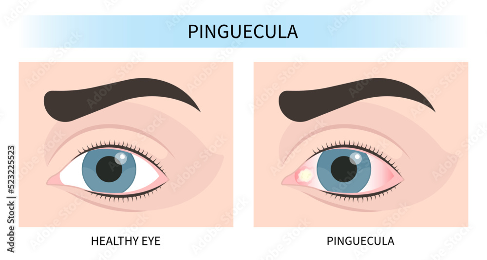 Stockvector conjunctival cyst swelling pink red surfer's eye blurry