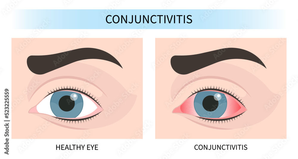 swelling eye vision loss and pink red surfer's blurry ulcer bacteria