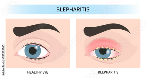 vision loss eye pain pink red surfer's blurry ulcer bacteria lens sores tear drop scars trauma conjunctival cyst swelling itchy dry uvea Stye injury
hordeolum pimple cellulitis pupil iris Anterior photo