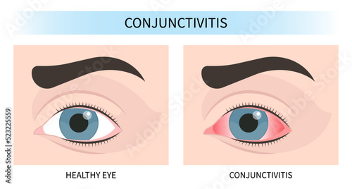 swelling eye vision loss and pink red surfer's blurry ulcer bacteria lens pain sores tear drop scars trauma conjunctival cyst itchy dry uvea Stye injury
hordeolum pimple cellulitis pupil iris Anterior photo