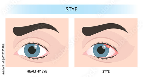 blurry vision and pink red surfer's eye ulcer bacteria lens loss pain sores tear drop scars trauma conjunctival cyst swelling itchy dry uvea Stye injury
hordeolum pimple cellulitis pupil iris Anterior