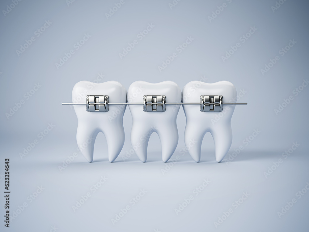 Teeth with or without braces. Arch braces without teeth. Orthodontic ...