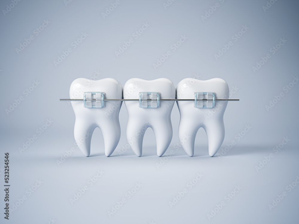 Teeth with or without braces. Arch braces without teeth. Orthodontic dentistry. The alignment of