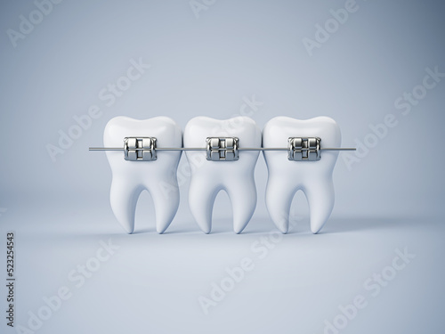 Teeth with or without braces. Arch braces without teeth. Orthodontic dentistry. The alignment of the teeth. Healthy lifestyle and dental care. Beautiful white teeth. 3d render photo