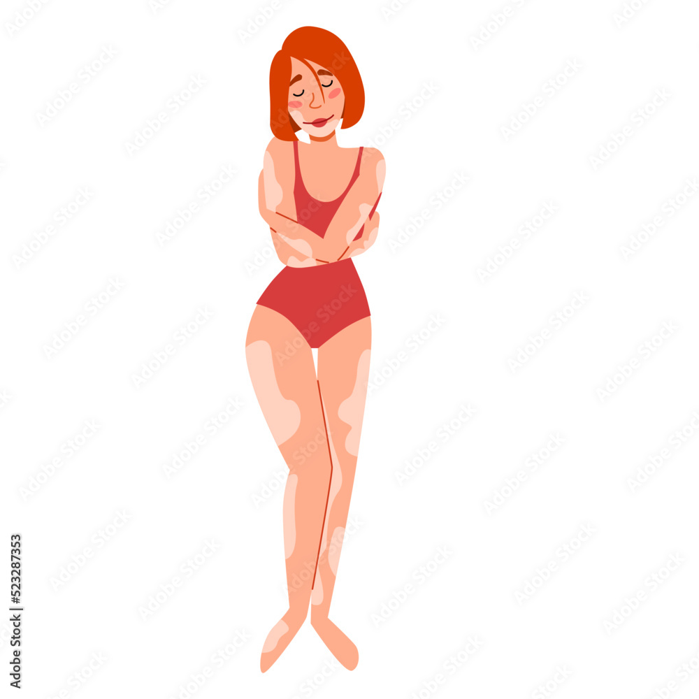 European slender woman with vitiligo. The girl hugs herself. The concept of body positivity, self-acceptance. skin disease vitiligo. Vector isolated illustration in a flat style on a white background. European slender woman with vitiligo. The girl hugs herself. The concept of body positivity, self-acceptance. skin disease vitiligo. Vector isolated illustration in a flat style on a white background.