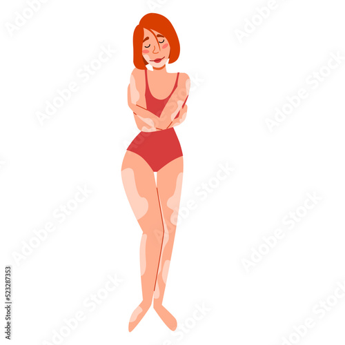 European slender woman with vitiligo. The girl hugs herself. The concept of body positivity, self-acceptance. skin disease vitiligo. Vector isolated illustration in a flat style on a white background.