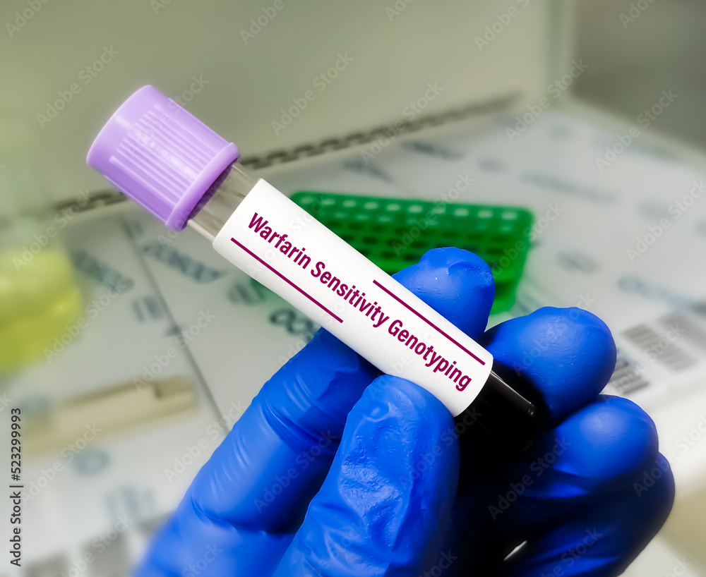 Warfarin Sensitivity Genotyping testing in PCR laboratory, to diagnose