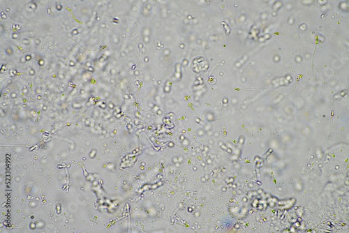 Sperm under the microscope. Looking a semen swimming. Healthy fertile man high sperm count