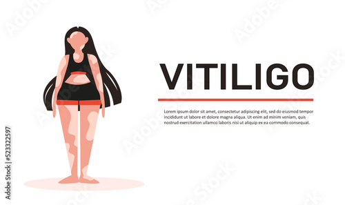 Vitiligo banner. Vitiligo girl. Banner for vitiligo clinic.
