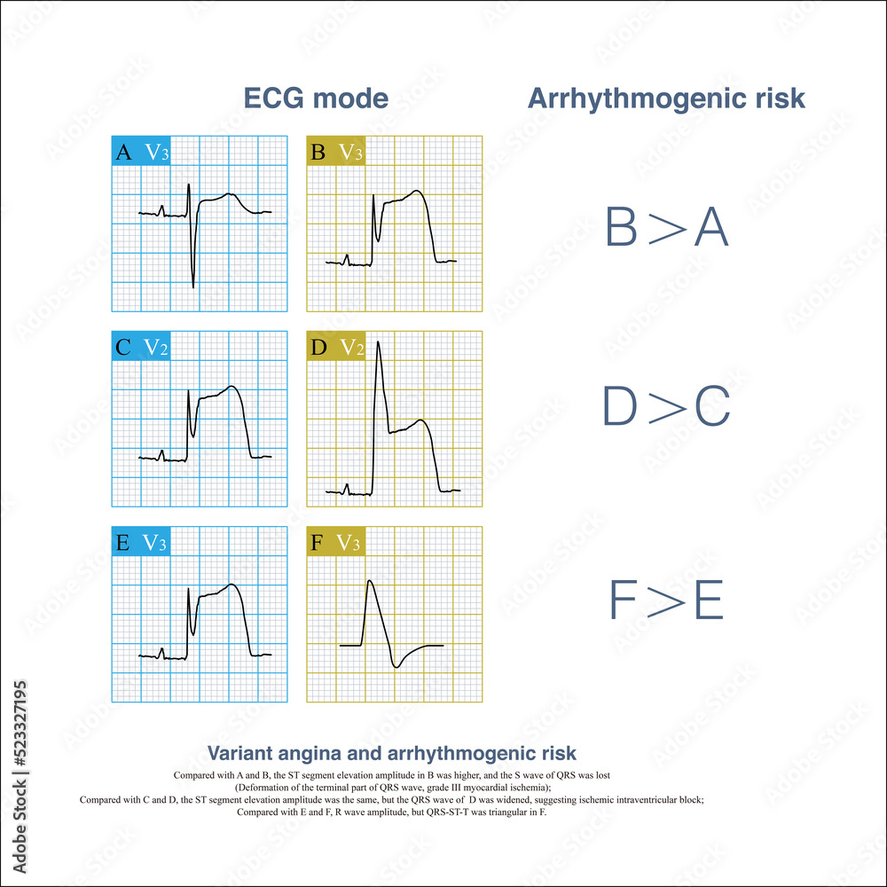 During the onset of variant angina pectoris, careful observation of QRS
