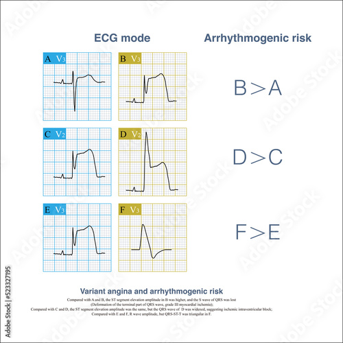 During the onset of variant angina pectoris, careful observation of QRS-ST-T morphology of ECG is helpful to identify patients with high-risk arrhythmia, and ECG monitoring should be strengthened.