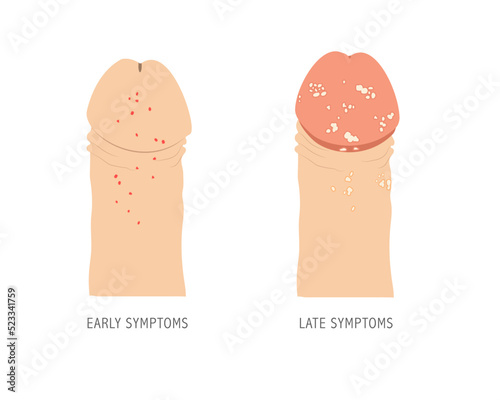 Human penis with early and late symptoms of STD genital herpes. Medical illustration for infographic. photo
