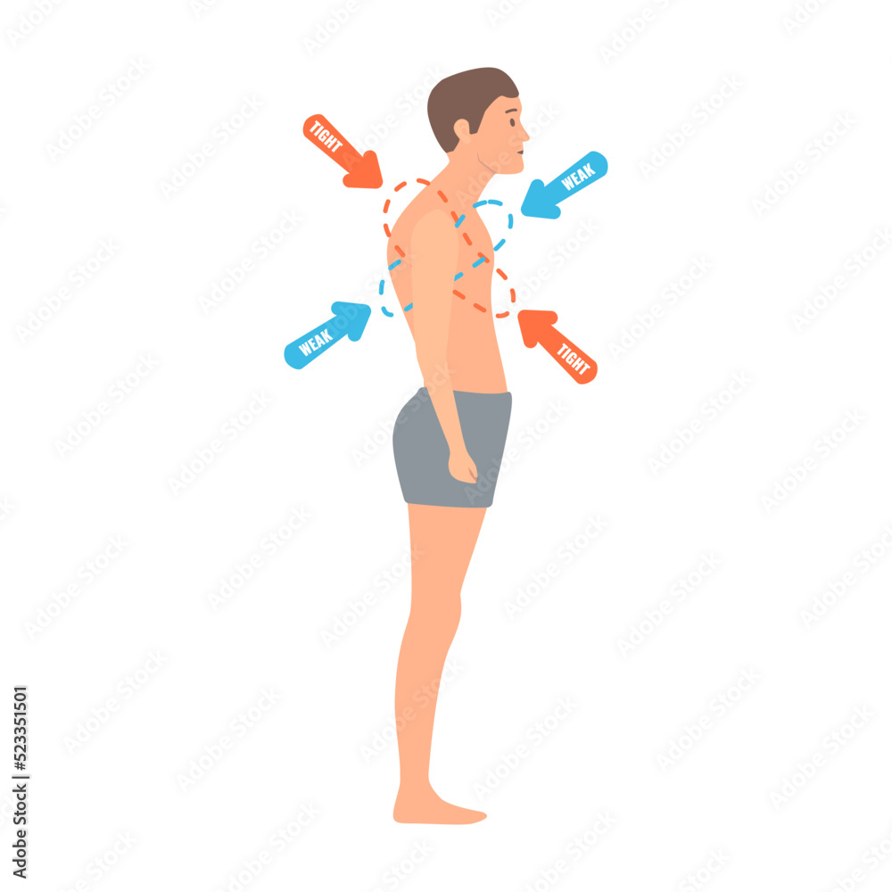 Upper crossed syndrome medical diagram. Crooked man with muscle strength imbalance. Weak and overactive muscles therapy. Incorrect spine curvature caused by bad posture. Vector illustration. Upper crossed syndrome medical diagram. Crooked man with muscle strength imbalance. Weak and overactive muscles therapy. Incorrect spine curvature caused by bad posture. Vector illustration.