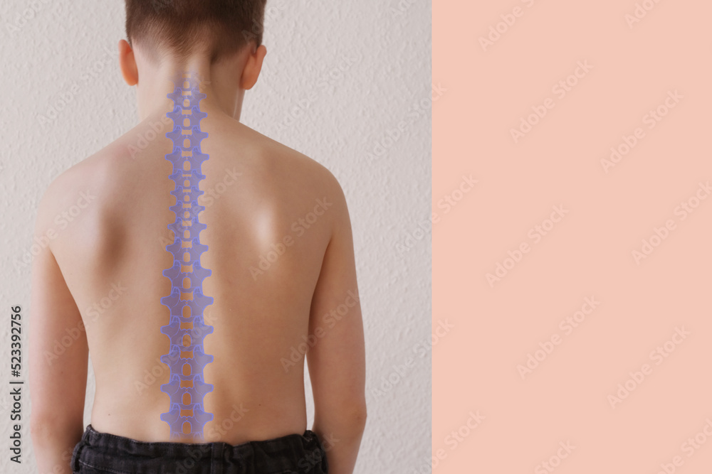 naked back of boy, child 8-10 years old, curved spine, vertebrae scheme ...