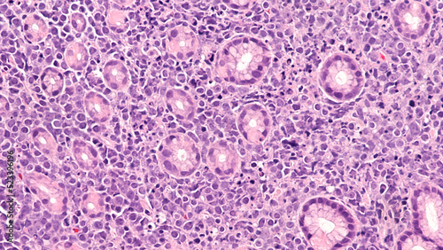 Fotografia Photomicrograph showing pathology of Burkitt lymphoma, a rare but highly aggressive (fast-growing) B-cell non-Hodgkin lymphoma (NHL), involving colon