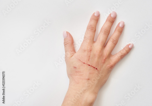 Female hand with cat scratches