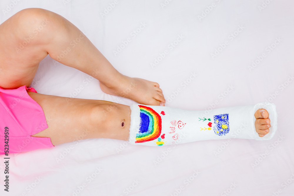 An unrecognizable little girl with a broken leg at home on the bed drew