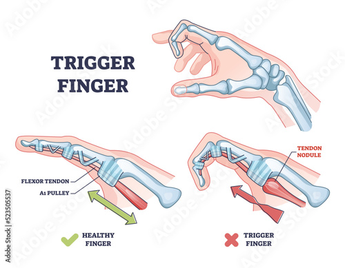 Trigger finger as finger stuck in bent position condition outline diagram. Labeled educational scheme with medical trauma with bending index finger, flexor tendon or pulley anatomy vector illustration photo