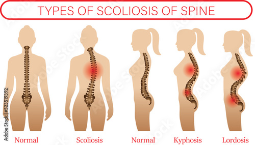Medical poster demonstrating types of scoliosis on white background. Illustration of healthy and diseased spine, banner design