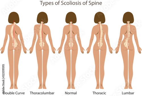 Medical poster demonstrating types of scoliosis on white background. Illustration of healthy and diseased spine photo