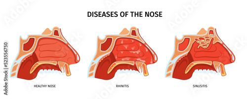 Diseases Of Nose Poster