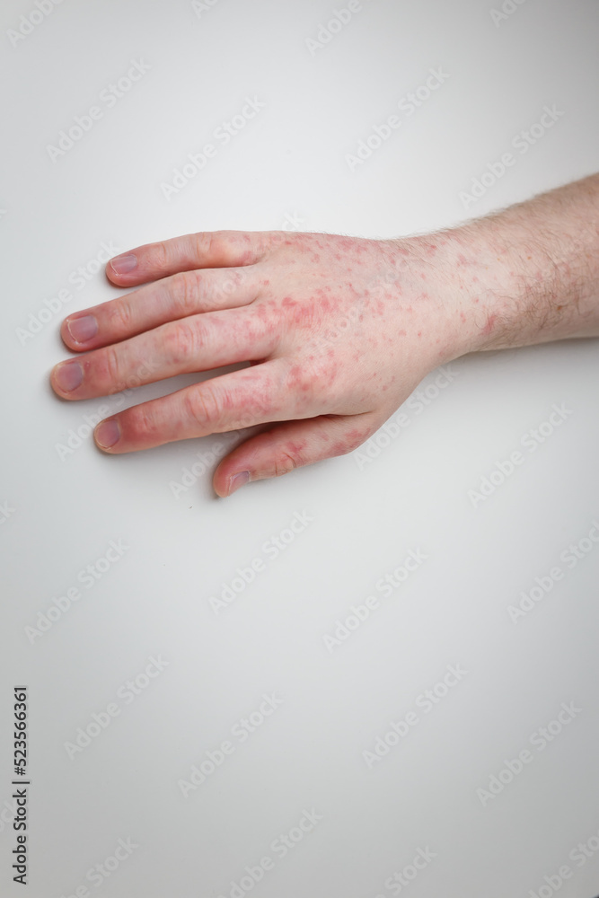 Patient shows arm and hand with red itchy painful rash. Allergic symptom on male hands. Dermatology, skin care. White background, top view Patient shows arm and hand with red itchy painful rash. Allergic symptom on male hands. Dermatology, skin care. White background, top view