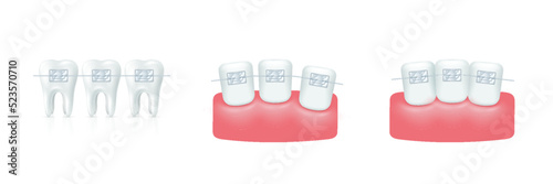 Teeth with braces set Orthodontic dentistry. Alignment of tooth. Healthy lifestyle and dental care