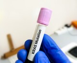 Molecular Biologist hold blood sample for KRAS mutation test for lung cancer.