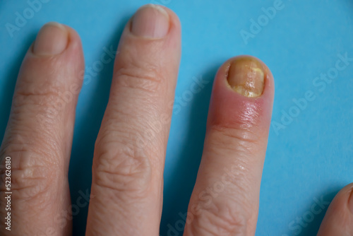 Paronychia disease of the fingernail photo