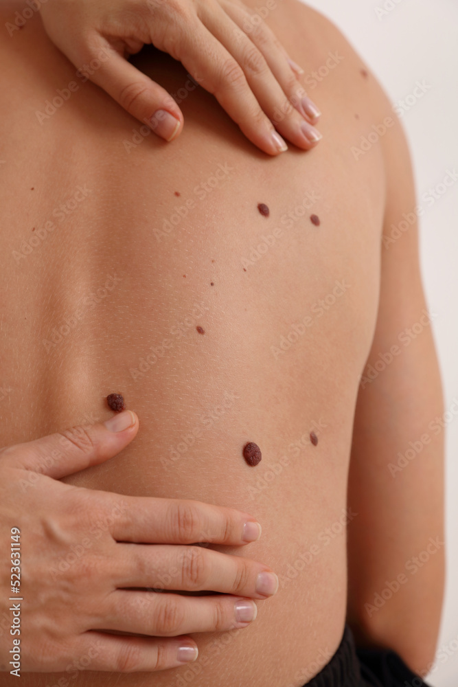 Doctor dermatologist examines patient birthmarks close up. Mole checkup. Skin tags removal