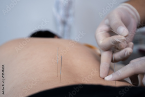 accupuncture to treat office syndrome