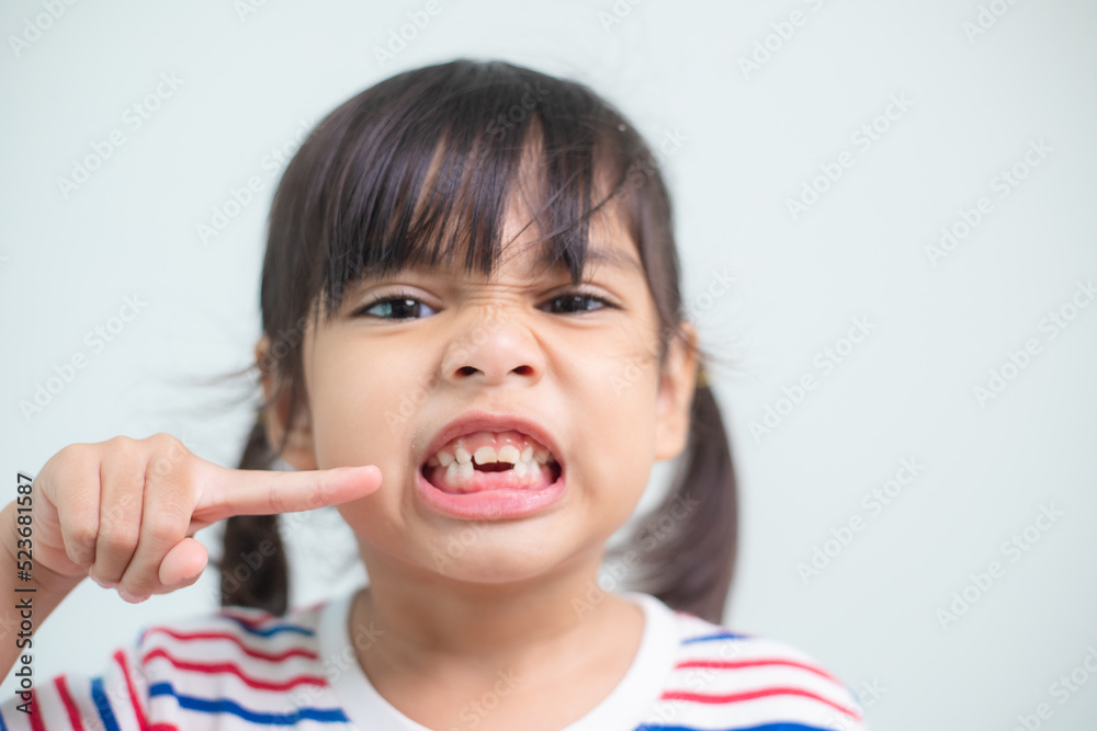 little Asian girl showing her broken milk teeth. little Asian girl showing her broken milk teeth.
