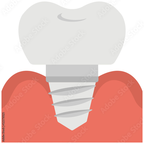 Tooth Implant 