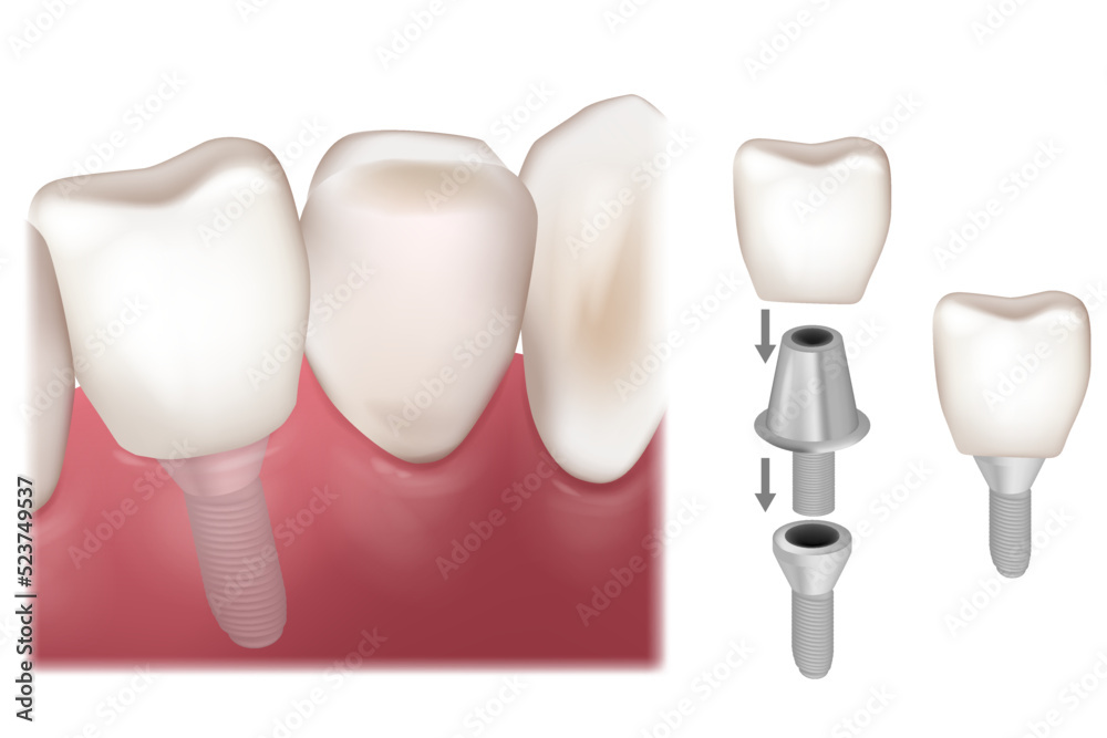 Dental Implant Recovery. Premolar tooth crown installation over implant