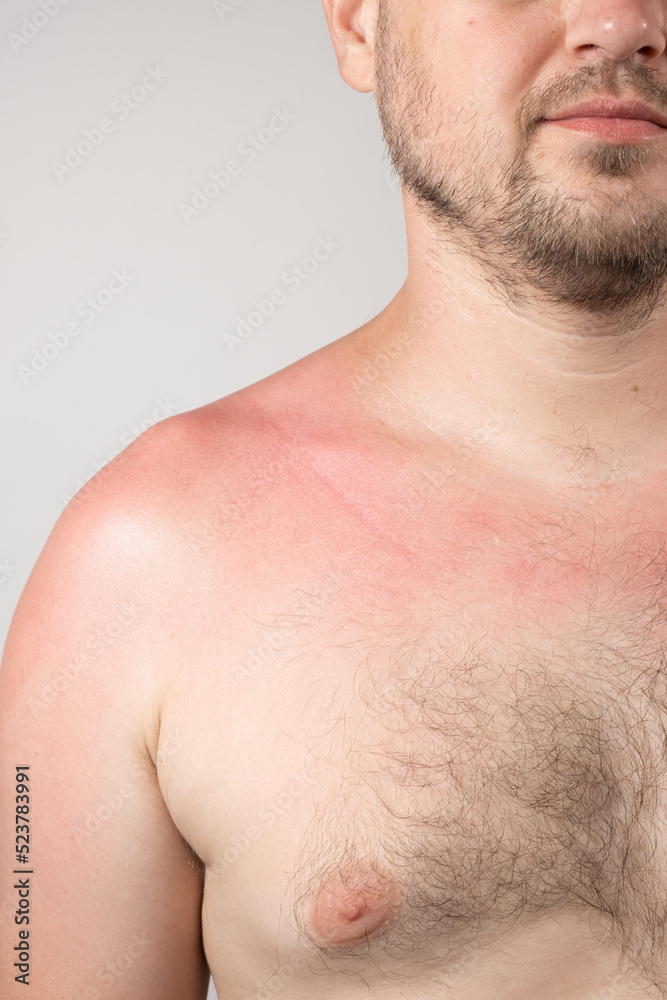 Fototapeta premium Skin of a person with sunburn, redness of the skin, close-up.