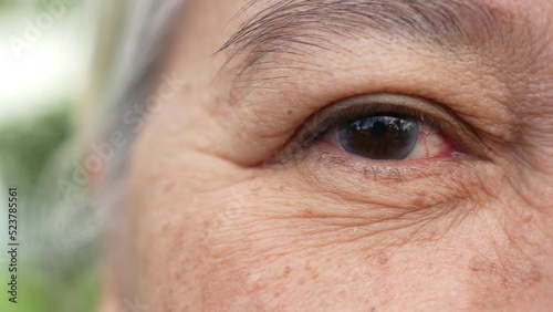 Close up of the senile cataract during eye examination. A white cloudy disc is seen in black eye circle, mature cataract, nuclear sclerosis cataract. Close up half face view