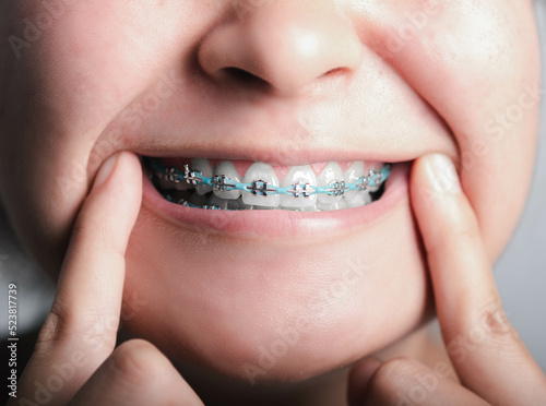 Dental Care, Orthodontic Treatment concept. Young woman Smile close up metal brackets on Teeth. Orthodontist brace teeth in mouth teenager macro shot Close Up of healthy female.