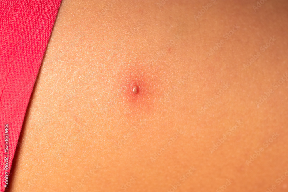 Close up picture of painful folliculitis on female leg. Shaving, infected follicle, dermatological concept Close up picture of painful folliculitis on female leg. Shaving, infected follicle, dermatological concept