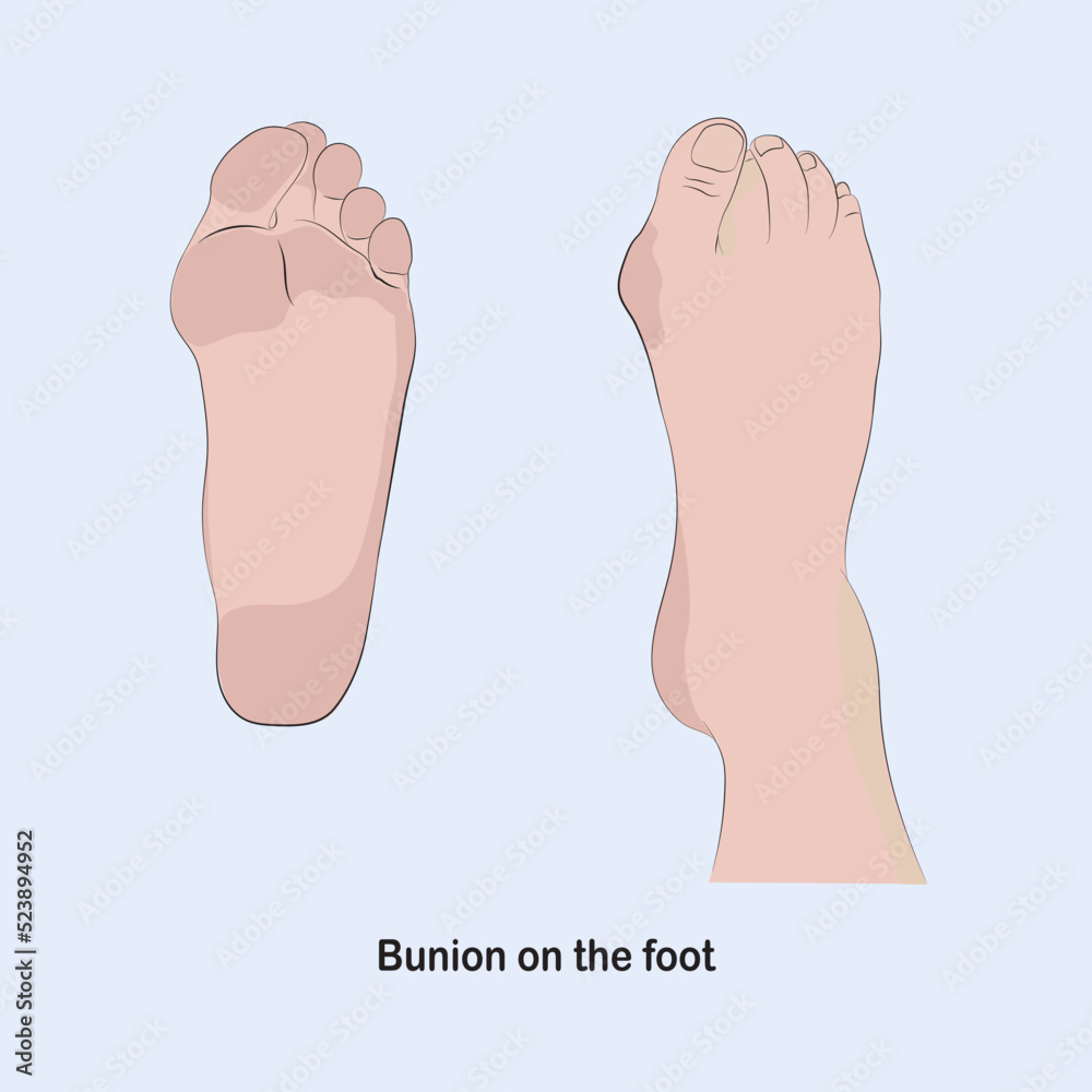 Bunion in the foot, causes the base of the toe to be pushed out of its normal position. Bunion in the foot, causes the base of the toe to be pushed out of its normal position.
