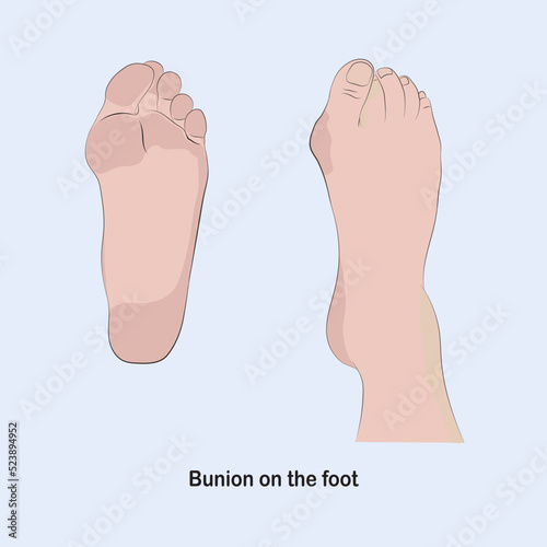Bunion in the foot, causes the base of the toe to be pushed out of its normal position.