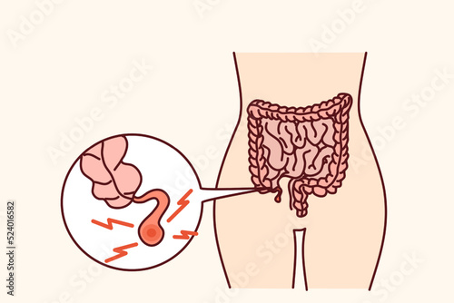Closeup of human body with inflamed appendix. Person suffer from appendicitis need surgery. Vector illustration. 