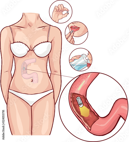 Capsule endoscopy vector illustration